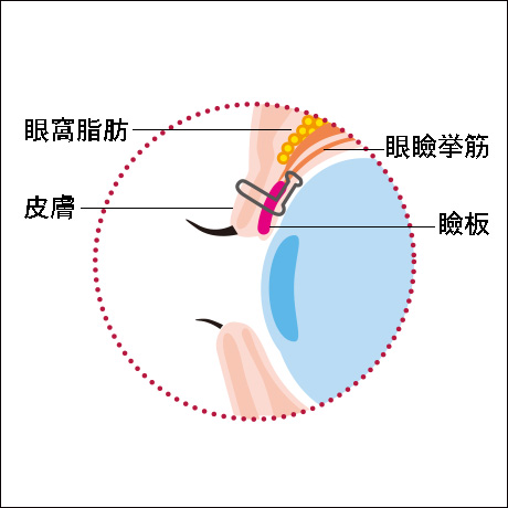 切らない眼瞼下垂