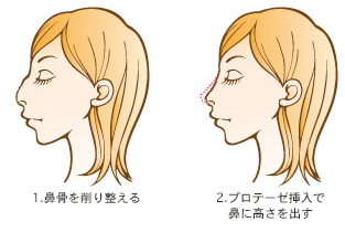 隆鼻(プロテーゼ)+ワシ鼻修正+鼻先