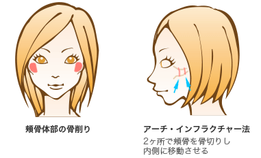 頬骨体部の骨削り/アーチ・インフラクチャー法
