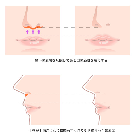 人中短縮術(リップリフト、上口唇短縮、鼻下短縮術)