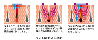 フォトRFによる脱毛