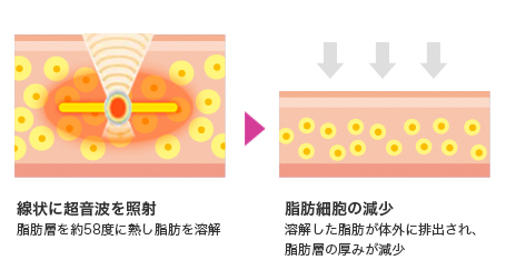 リニアハイフ(脂肪溶解ハイフ)のしくみ