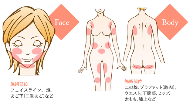 リニアハイフ(脂肪溶解ハイフ)の照射部位