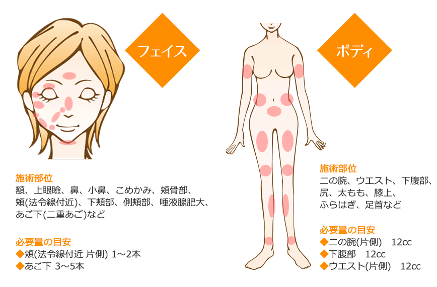 BNLS注射の施術部位