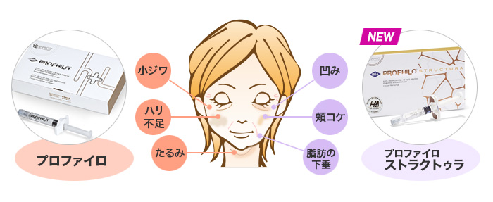 プロファイロとプロファイロ ストラクトゥラ（プロファイロ ストラクチュラ）の特徴