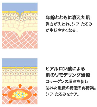 ヒアルロン酸で肌全体を再構築(リモデリング)