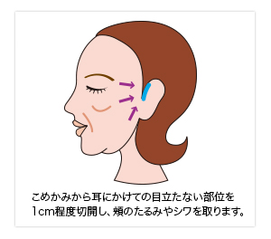プチリフト