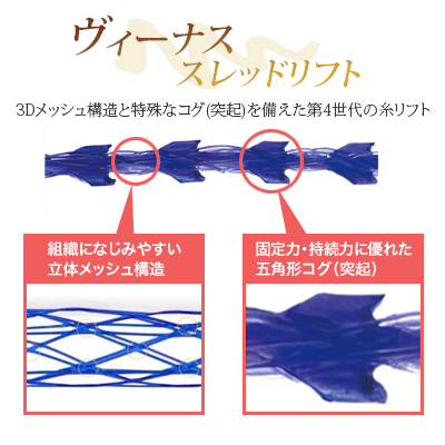ヴィーナススレッドリフト 3Dメッシュ構造と特殊なコグ(突起)を備えた第4世代の糸リフト