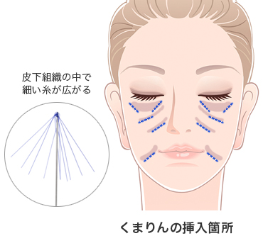 くまりんの挿入箇所
